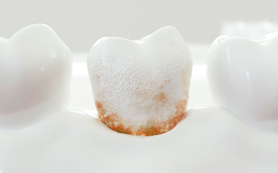 歯周病、虫歯の原因となる歯垢（プラーク）とは